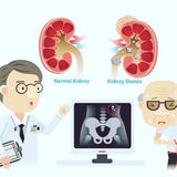 Kidney Stones Cálculos Renales